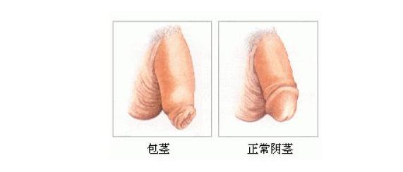 包皮包茎为什么要及时治疗