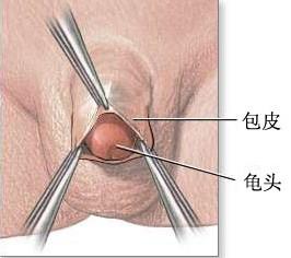 男性包茎会引发什么病