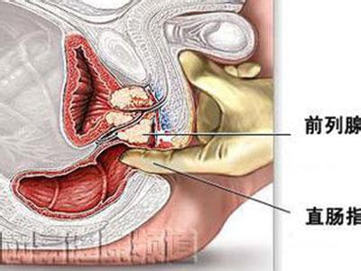 前列腺炎早期的症状