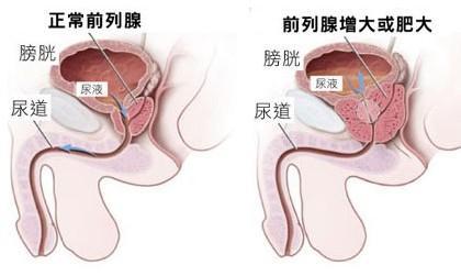 前列腺炎都有啥危害