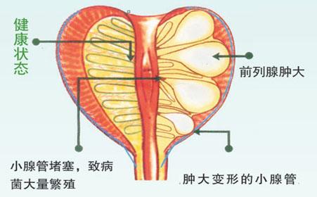 前列腺囊肿的基本形成原因