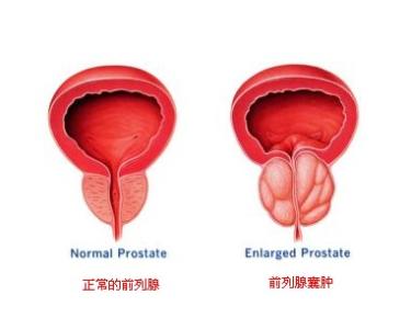 前列腺囊肿症状大揭秘
