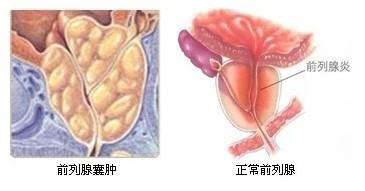 前列腺囊肿发作特点