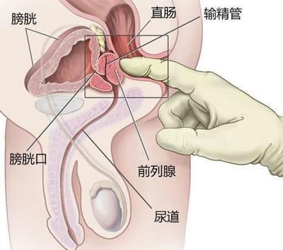 前列腺囊肿复发原因