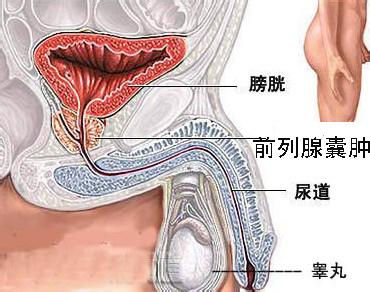 前列腺囊肿患者的饮食注意事项