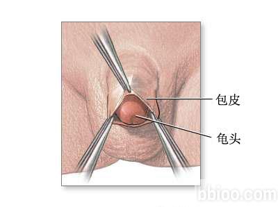 包皮手术哪种方法好？