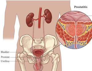 男性前列腺痛的病因有哪些