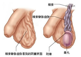 附睾结核易导致不育的原因是?