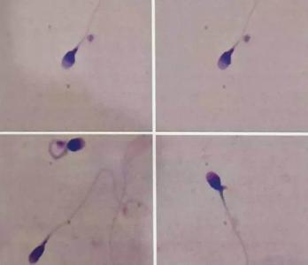 治疗射精障碍有哪些检查项目？费用多少